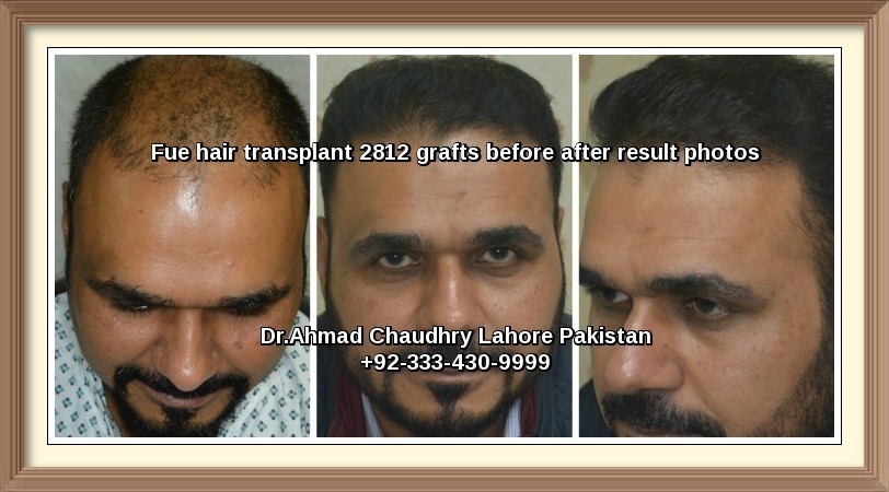 Best hair transplant results Lahore Pakistan