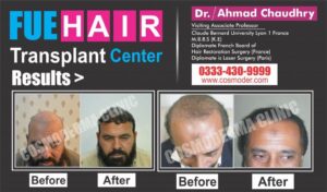 Read more about the article BEST HAIR TRANSPLANT RESULTS