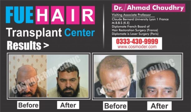 Best hair transplant results Pakistan | Best hair restoration clinic surgeon
