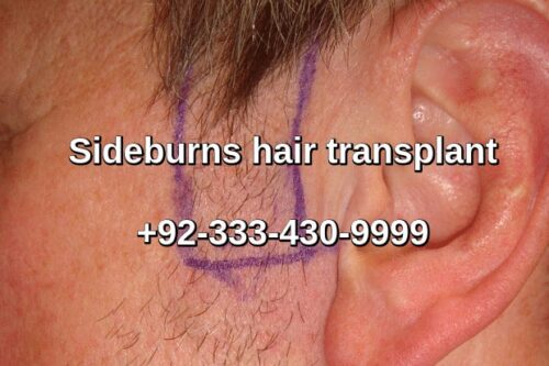 Read more about the article Sideburns restoration