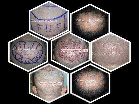 Process of hair transplant