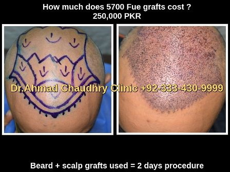 5700 Fue grafts price Pakistan