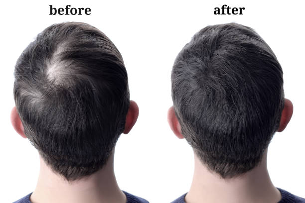 Baldness treatment Pakistan