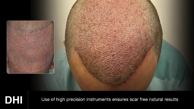 DHI hair transplant in Lahore Pakistan | Direct hair implant | Call us