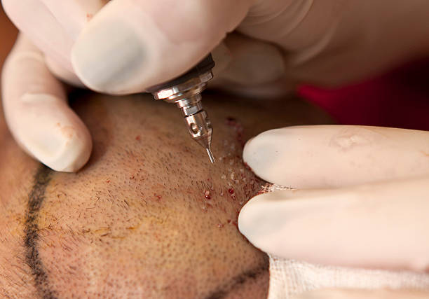 Fue hair transplant young patient