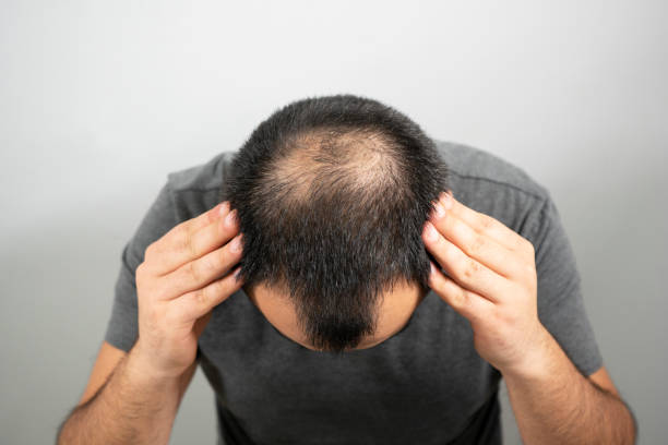 Hair loss remedies