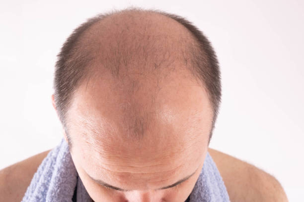 Complete baldness recovery Pakistan