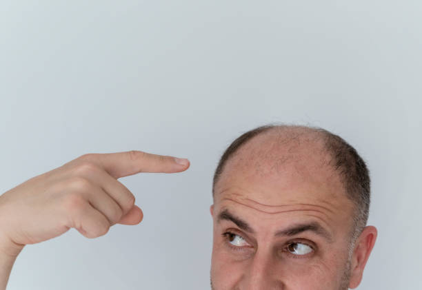 male pattern baldness treatment Pakistan