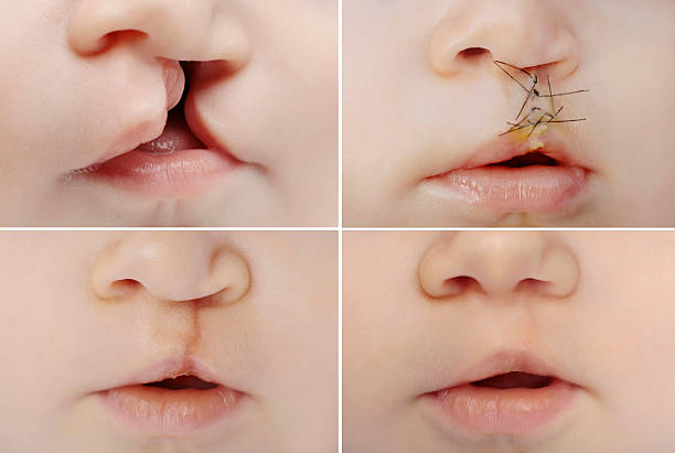 Read more about the article Cleft lip scar fixing