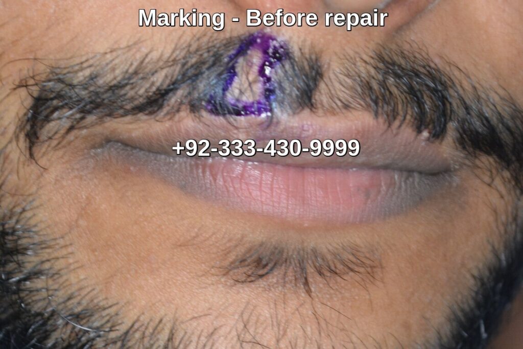 Cleft lip scar marking
