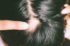 Burn scar alopecia