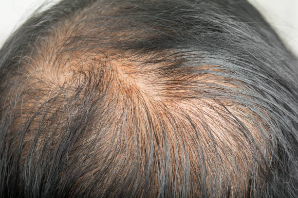 Hair fall and treatment Lahore