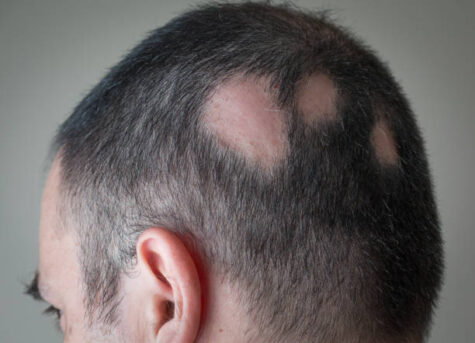 Read more about the article Hair transplant burn scar