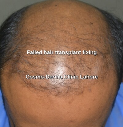 Hair transplant complications | Risks and management | Fue clinic Pakistan