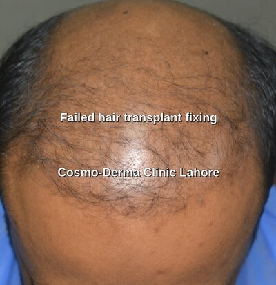 Hair transplant complications