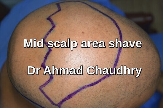 Shave before Fue procedure recipient area