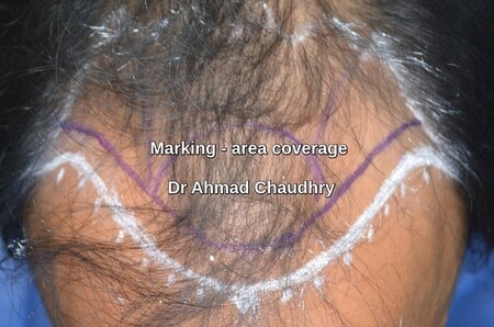 Baldness area coverage marking