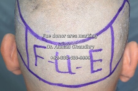 Fue hair transplant Arifwala Patient