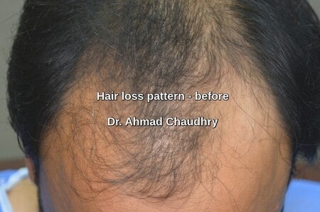 Hair loss Arifwala patient