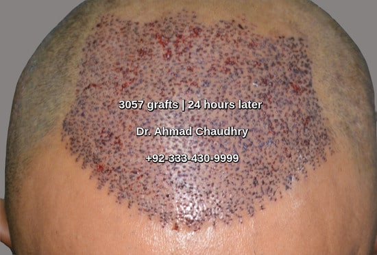 3057 grafts hair transplant Okara patient