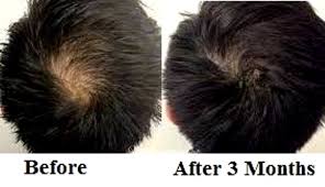 Crown hair loss treatment Lahore Pakistan