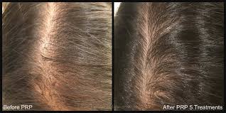 Female hair fall treatment Lahore Pakistan