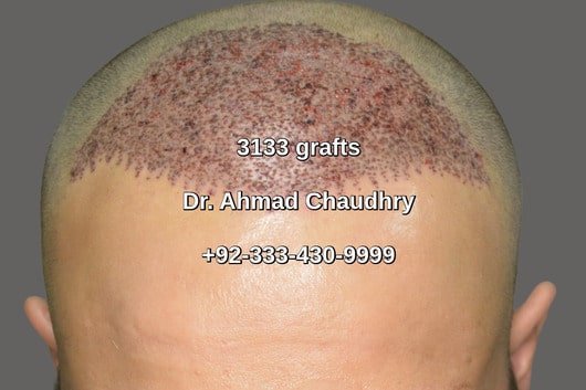 Front view 3133 grafts hair transplant Nottingham UK