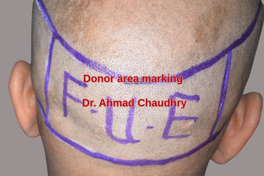 Fue donor area -Okara patient