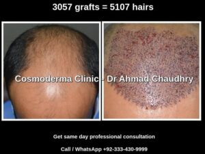 Read more about the article Hair transplant Okara