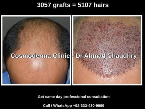 You are currently viewing Hair transplant Okara