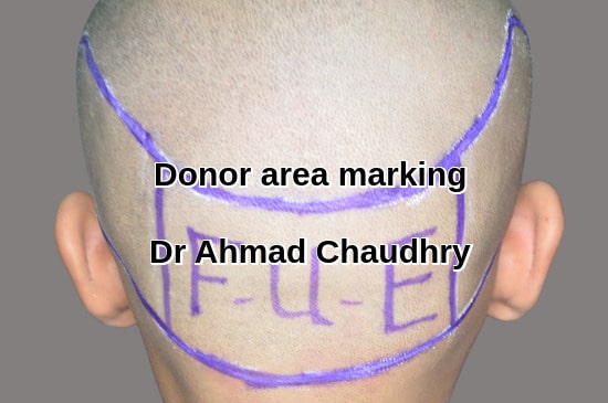 Fue hair transplant donor area UK patient