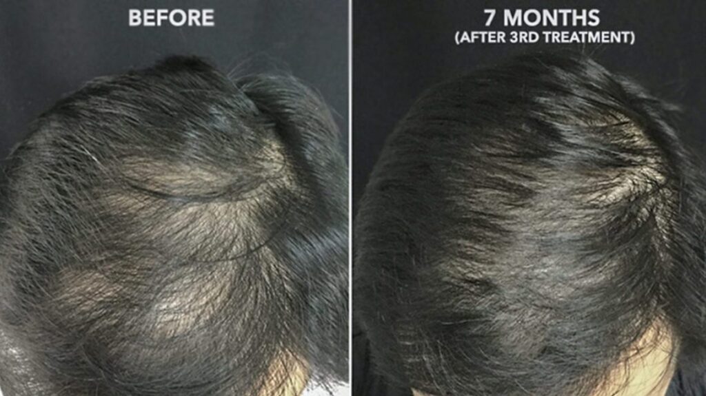 Hair fall treatment results Lahore Pakistan