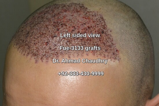 Left view -hair restoration Nottingham UK