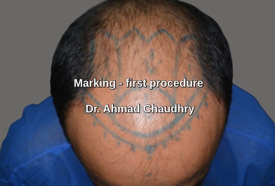 Marking baldness area before procedure