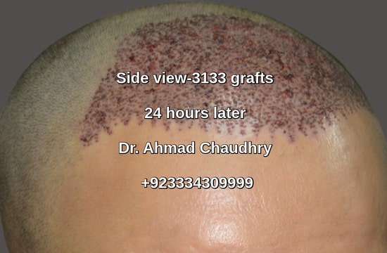 Right view male pattern baldness Nottingham UK