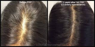 Women hair thinning specialist clinic result