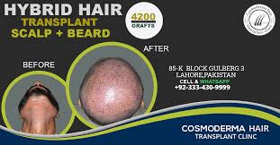 Hybrid hair transplant Lahore Pakistan