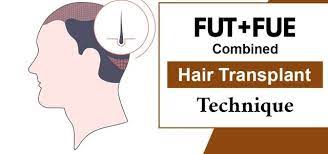 fut fue combination hair restoration surgery Lahore Pakistan