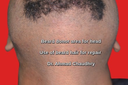Beard donor area use for repair