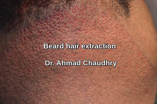 Beard hair extraction 1614 grafts