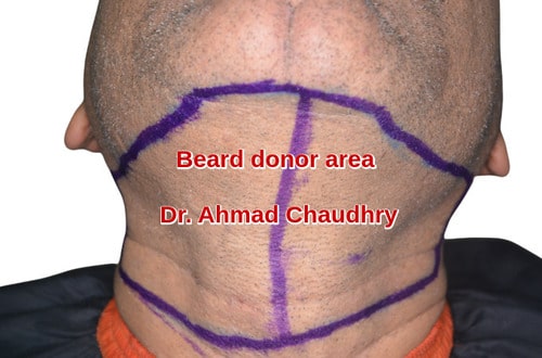 Beard hair use Ahmadpur sial patient