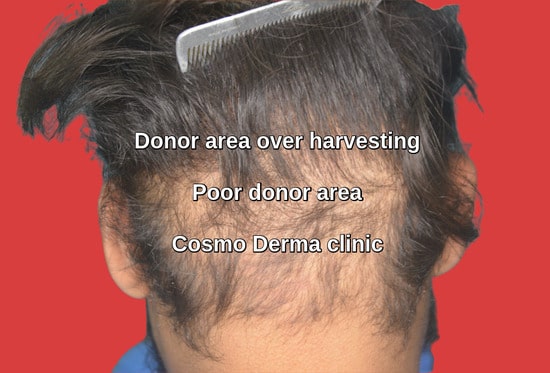 Botched donor area after hair transplant