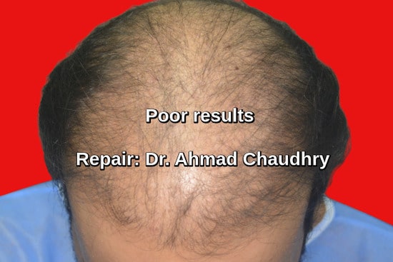 Botched hair transplant Bahawalpur patient | 1614 beard grafts use