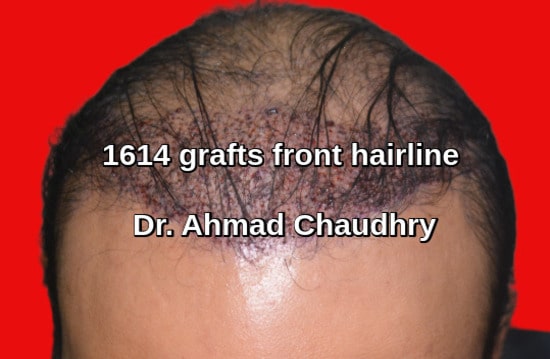 Botched hair transplant repair