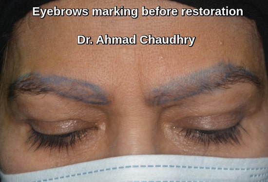 Eyebrows hair transplant Karachi patient