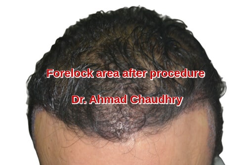 Frontal forelock area restoration