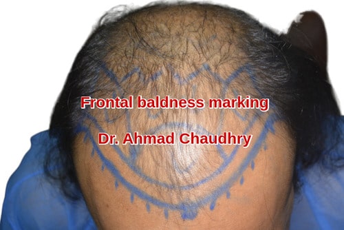 Frontal half hair restoration Pakistan