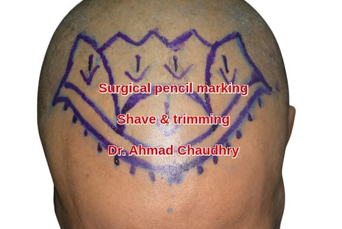 Fue hair transplant Pakistan patient
