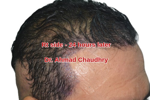 Fue hair transplant Swat patient