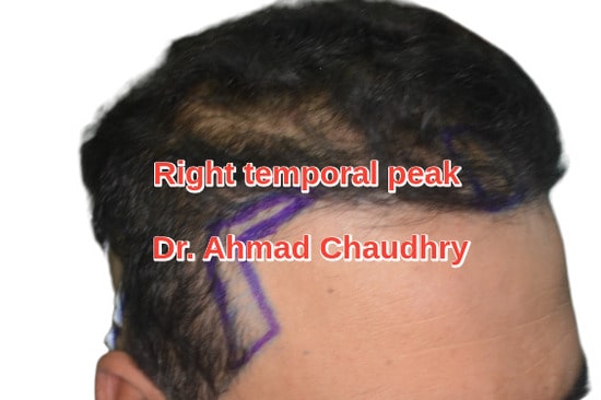 Hair loss designing Swat patient